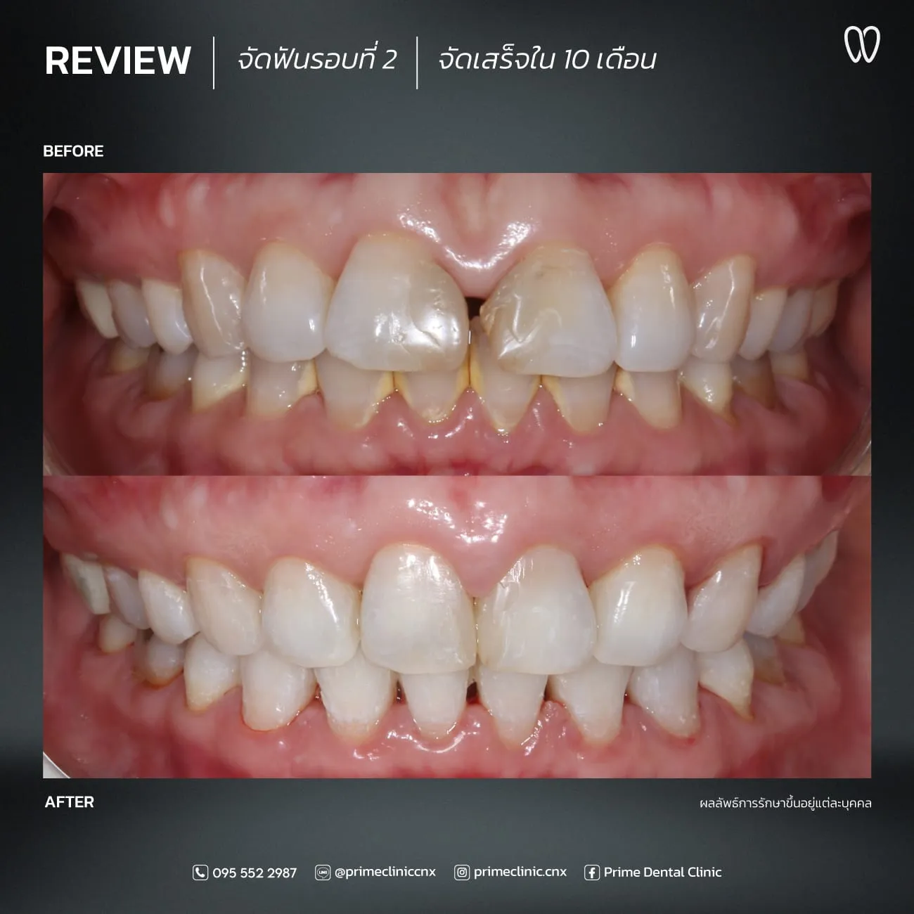 จัดฟัน 6