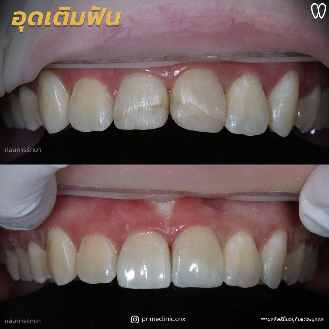 อุดปิดช่องฟันห่าง 2