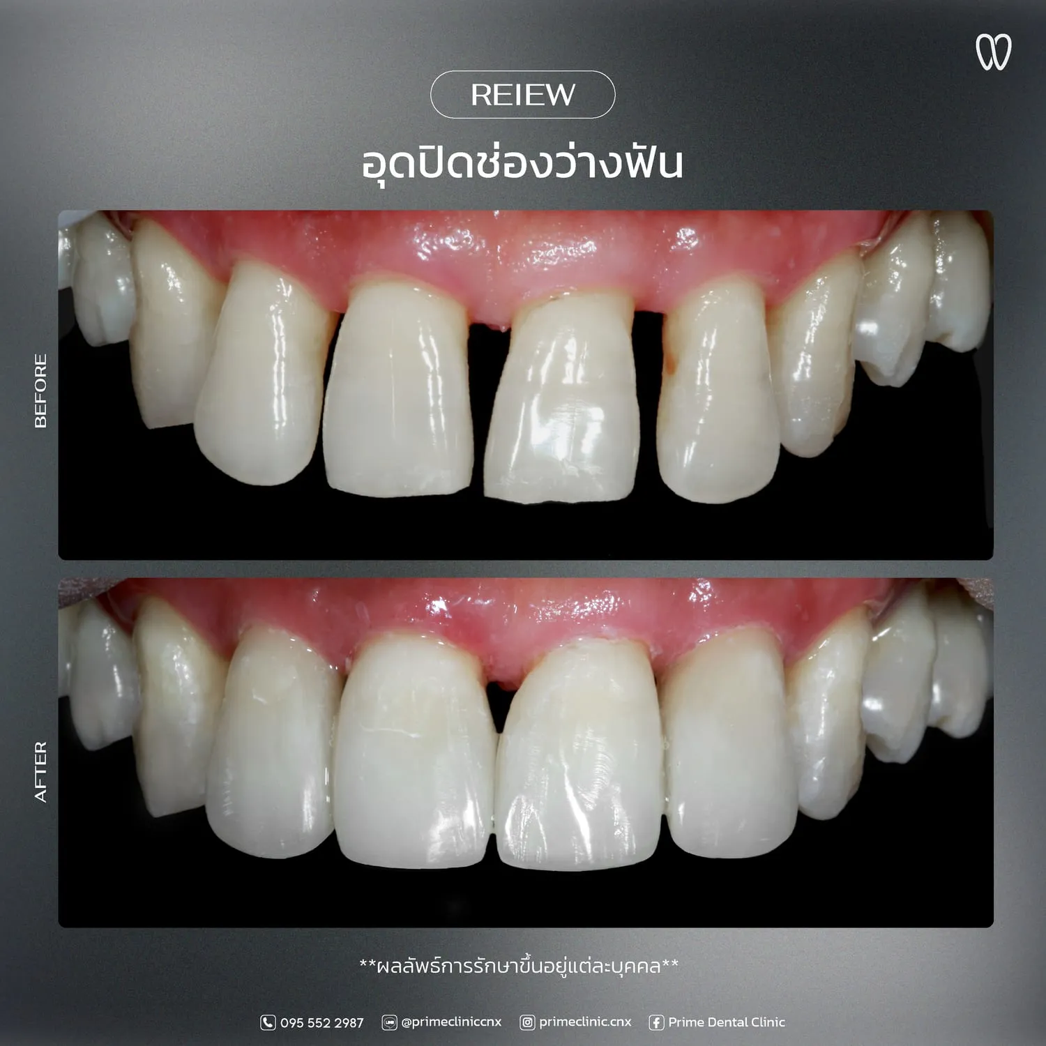 อุดปิดช่องฟันห่าง 4