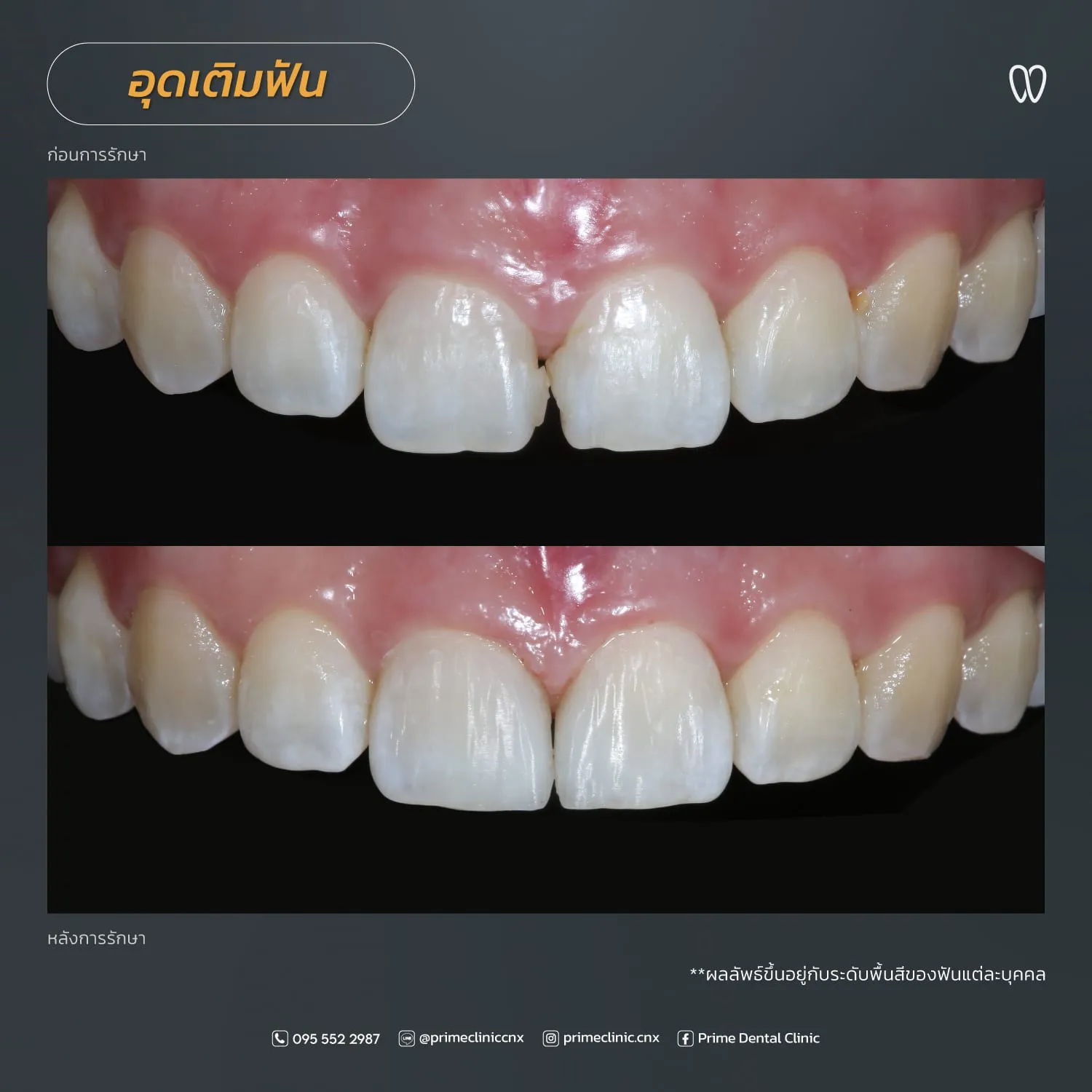 อุดปิดช่องฟันห่าง 5