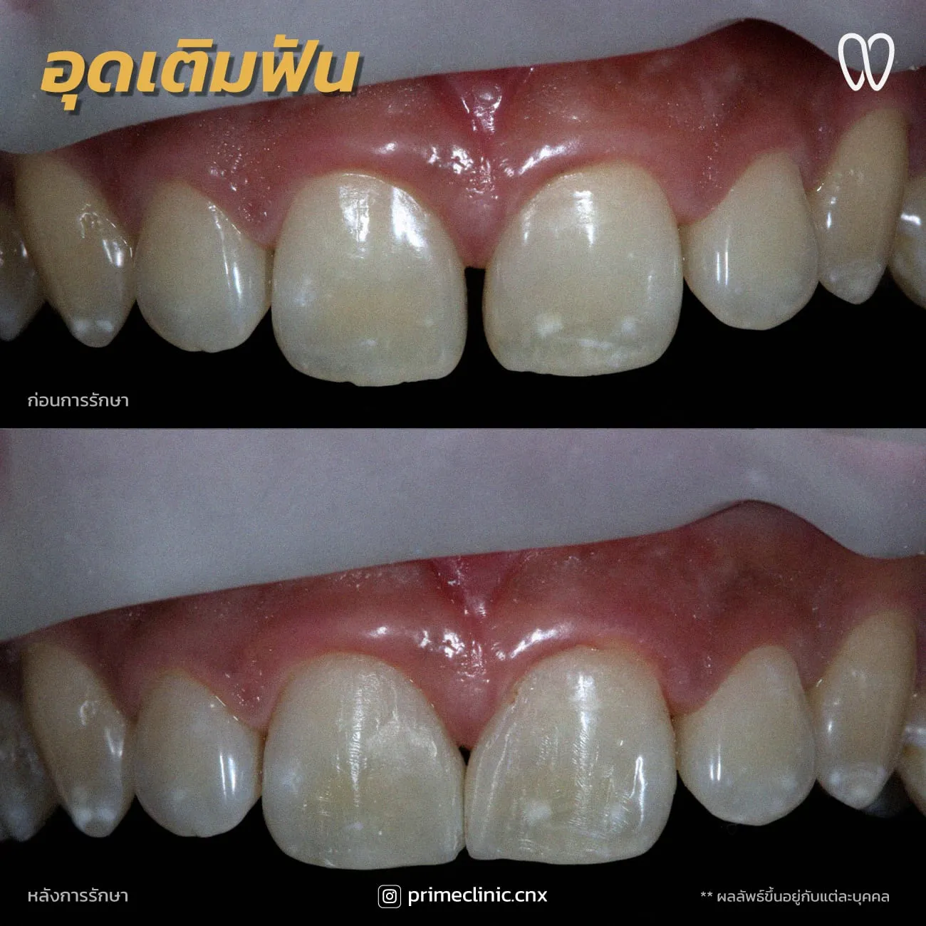 อุดปิดช่องฟันห่าง 6