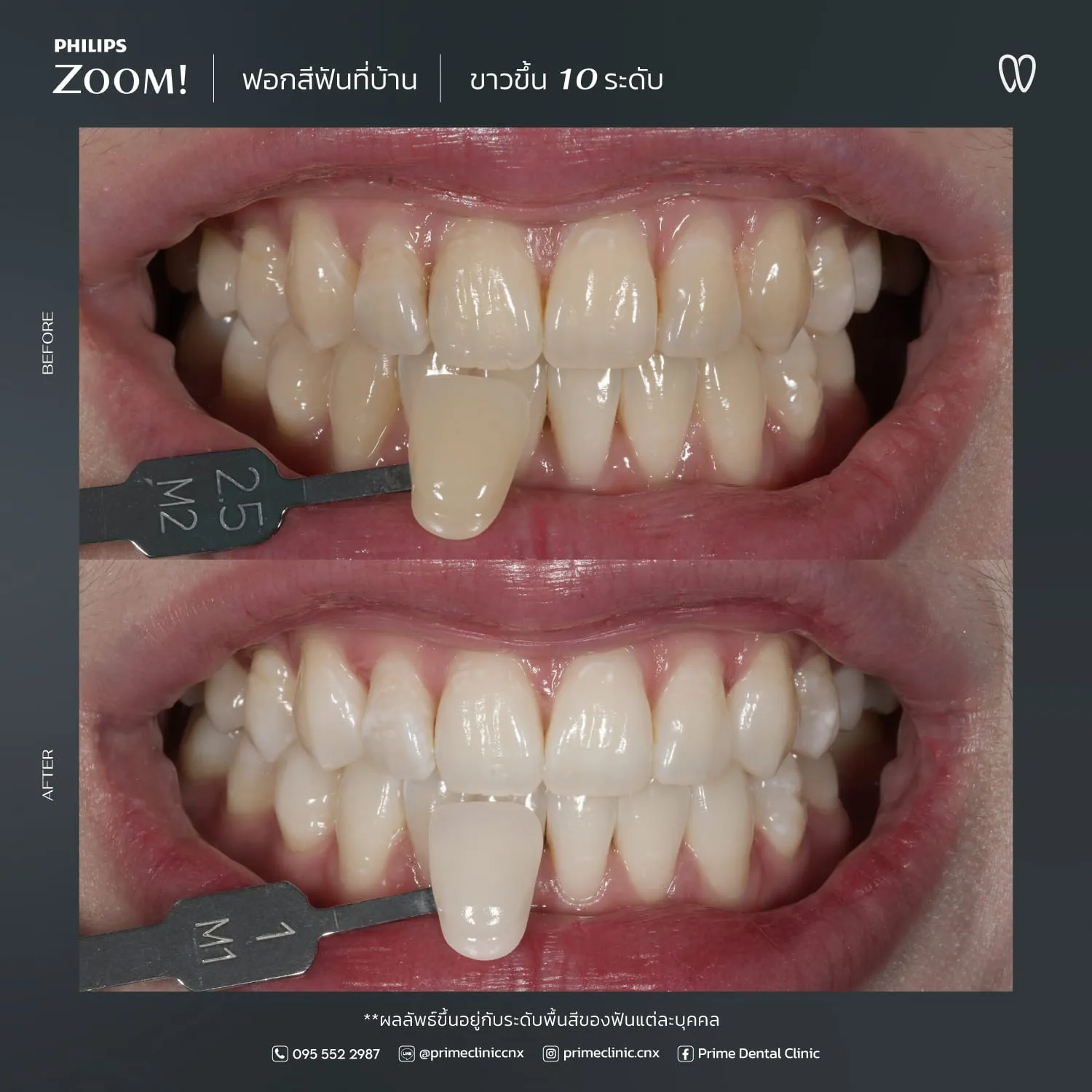 ฟอกสีฟัน 3